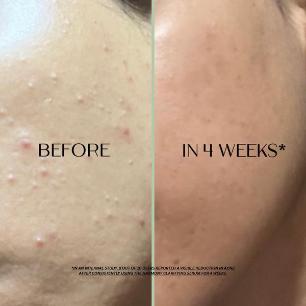 Harmony Azelaic Acid Serum - for acne-prone, inflamed, hormonally reactive skin