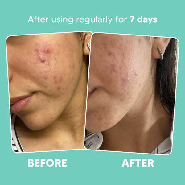 Clarifying Face Oil - Argan & Tea Tree for Calm & Clear Skin
